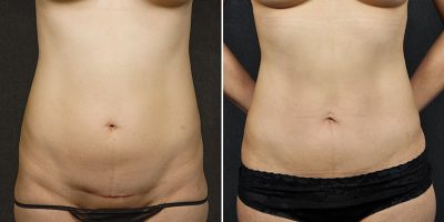 Tummy Tuck Before and After Photo Gallery, Albany & Latham, New York