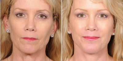Give Yourself A Natural Face-Lift In 2 Weeks - Natural Health