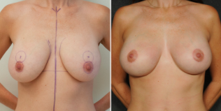 Alexandra Breast Lift: A Hybrid, No-Scar, Better Breast Lift - Los